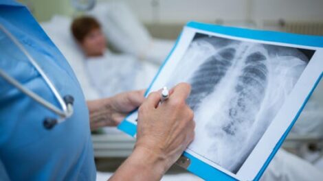 Új szakorvosképzés indul a tüdőrák elleni küzdelemben